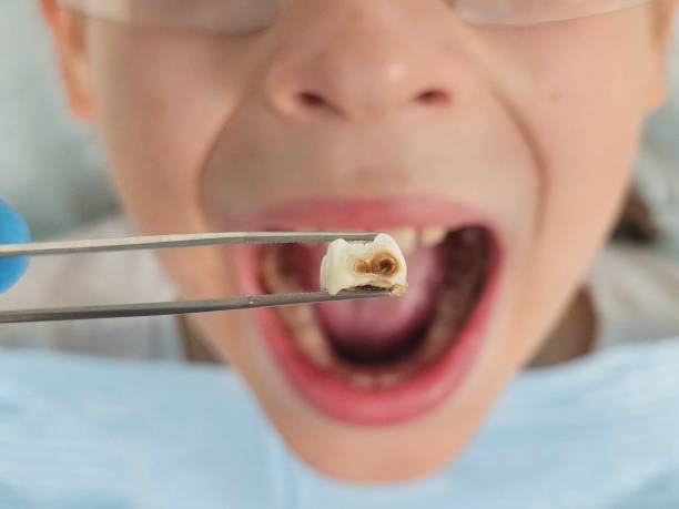 Best Knocked-Out Tooth (Avulsed Tooth) Treatment in Cumings, TX